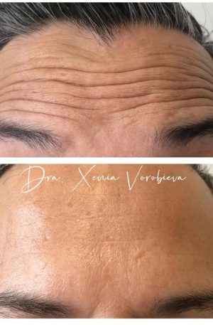 Neuromoduladores – Tercio Superior – 450 €