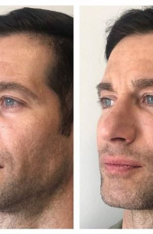 Marcación del Mentón