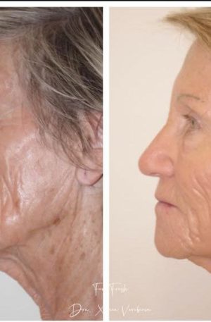 Bioestimulador Facial