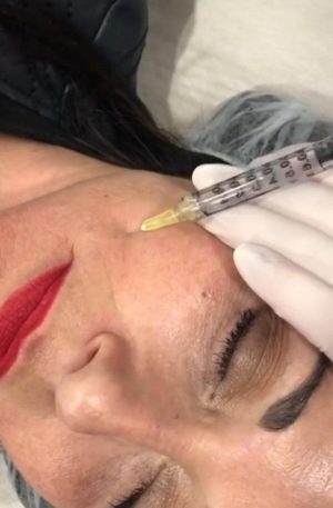 PRP – Plasma Rico en Plaquetas