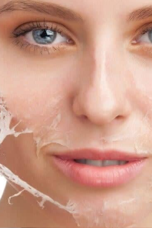 Peeling Químico