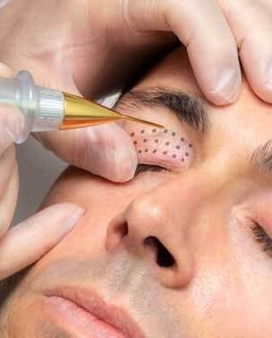 Blefaroplastia No Quirúrgica con Plasmage